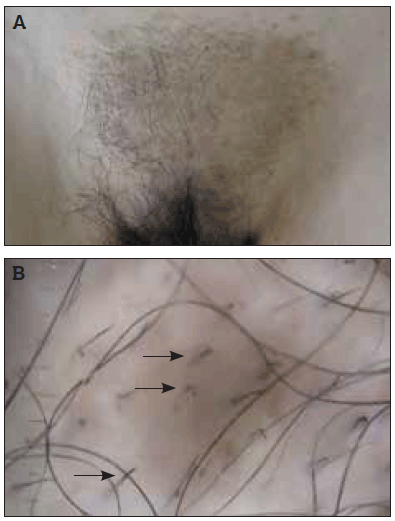 craig kalman recommends pussy hair pull pic