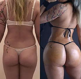 pornstars with butt injections